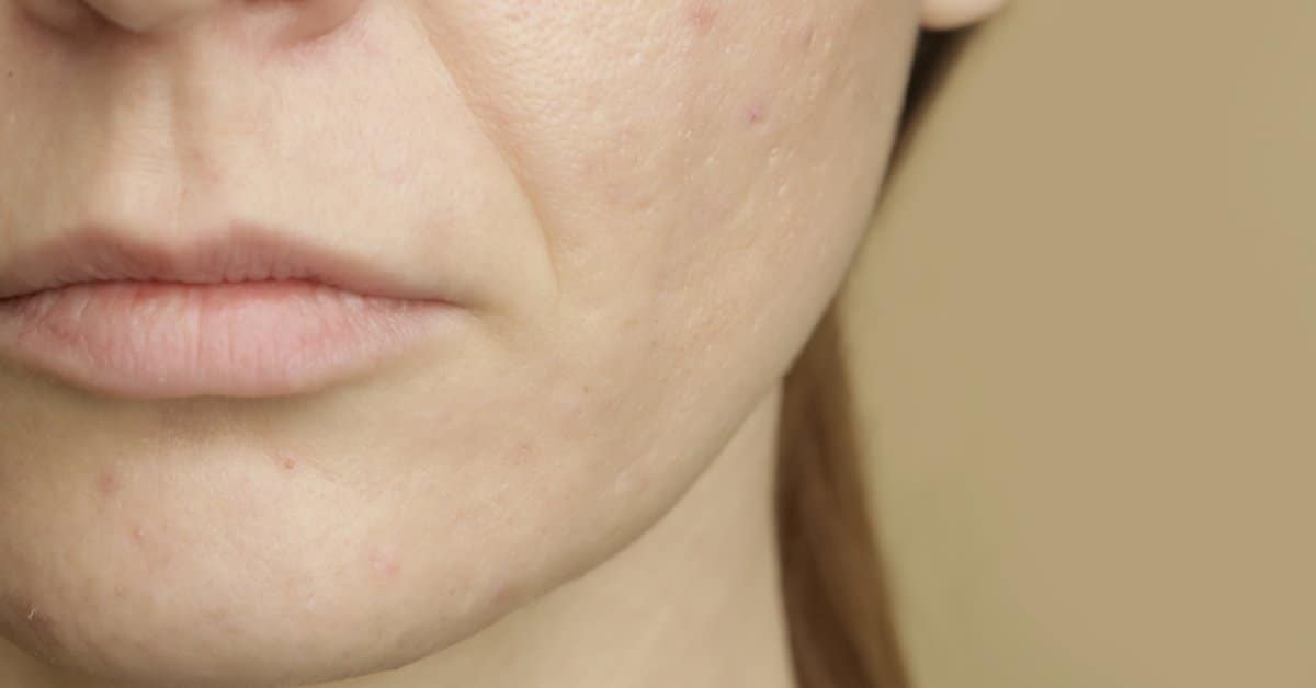 أفضل الطرق للعناية بالبشرة الجافة خلال الطقس البارد - تعريف البشرة الجافة وأسبابها